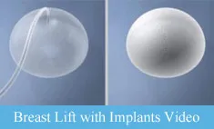 Breast Lift with Implants Video