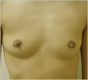 Breast augmentation before photo 1