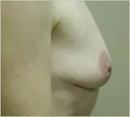 Breast augmentation before photo 3
