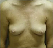 Breast augmentation before photo 1