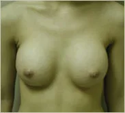 Breast augmentation after photo 1