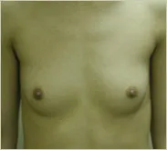 Breast augmentation before photo 1