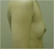 Breast augmentation before photo 3