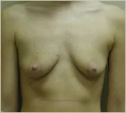 Breast augmentation before photo 1