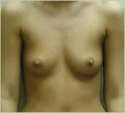 Breast augmentation before photo 1